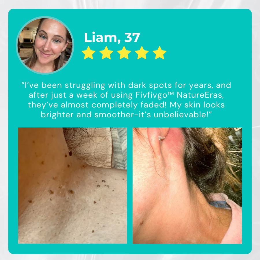 Instant Mole & Spot Cream Erase Unwanted Marks in 7 Days Without Surgery, Pain, or $650 Doctor Bills