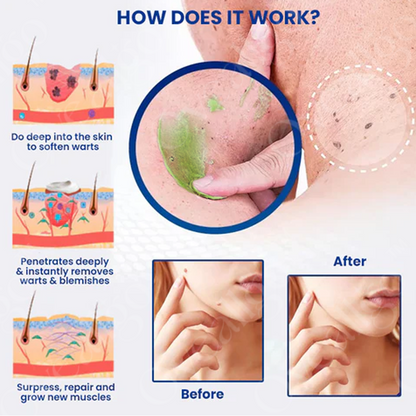 Instant Mole & Spot Cream Erase Unwanted Marks in 7 Days Without Surgery, Pain, or $650 Doctor Bills