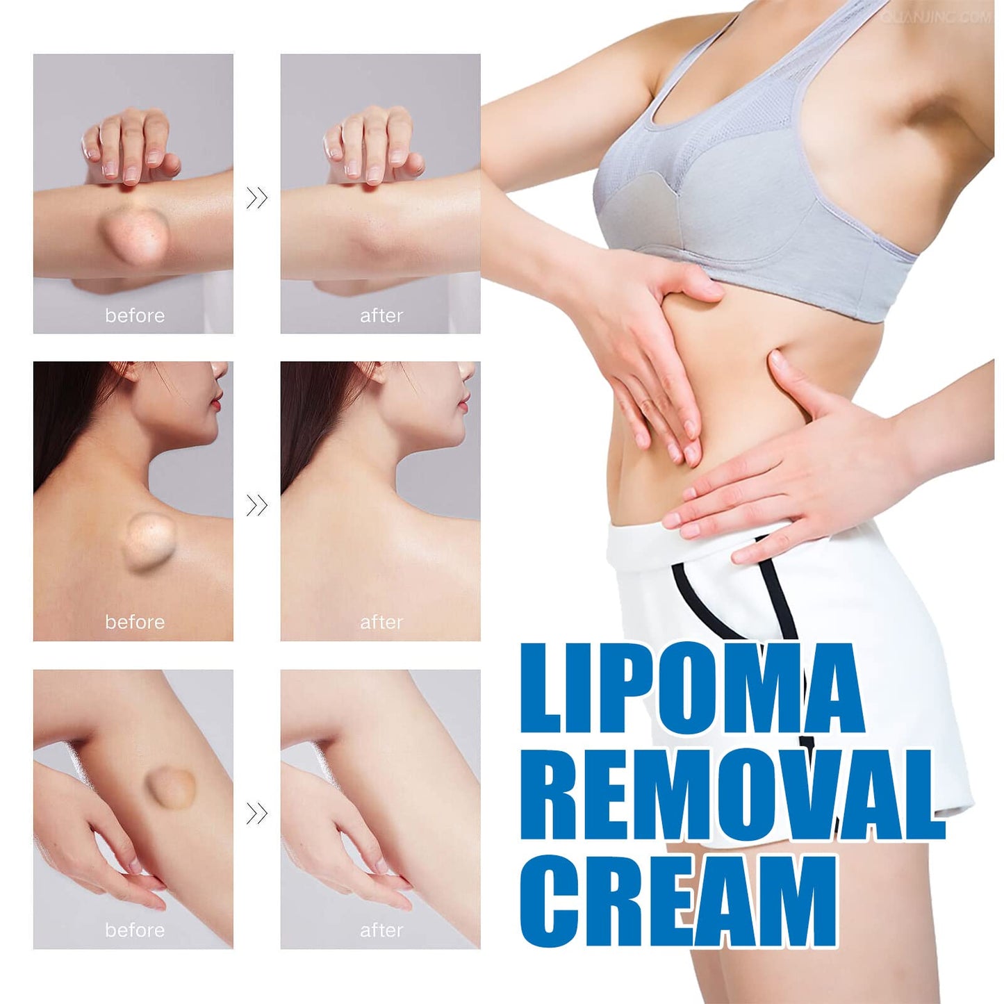Lipoma Removal Cream Plant Extract Tumors Treat Skin Swelling Ointment Relief
