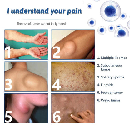 Lipoma Removal Cream Plant Extract Tumors Treat Skin Swelling Ointment Relief